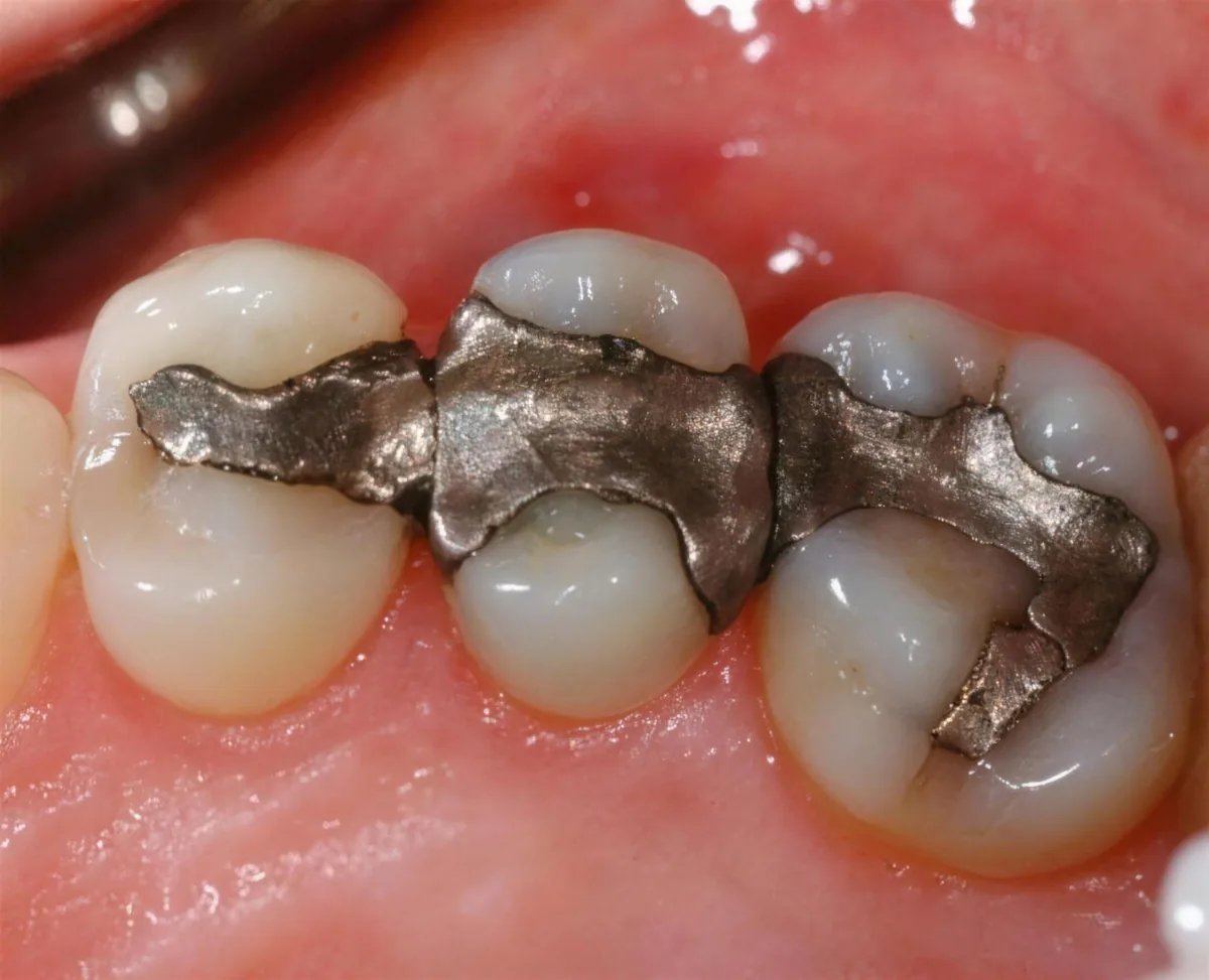 Close-up of old silver amalgam (mercury) fillings before safe SMART removal at Green Dentistry: Root and Restore in Alexandria, VA