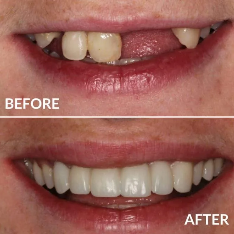 Before and after of a metal-free cosmetic restoration replacing missing and worn teeth at Green Dentistry: Root and Restore in Alexandria, VA