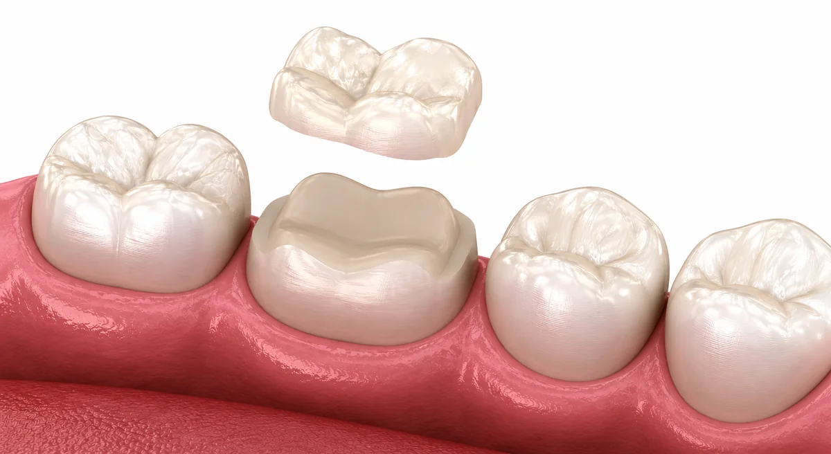 Metal-free ceramic onlay restoration placed on a tooth at Green Dentistry: Root and Restore in Alexandria, VA