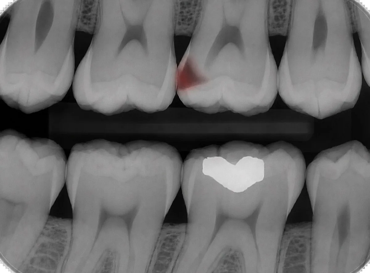 Diagnostic dental X-ray showing a deep cavity reaching toward the nerve at Green Dentistry: Root and Restore in Alexandria, VA