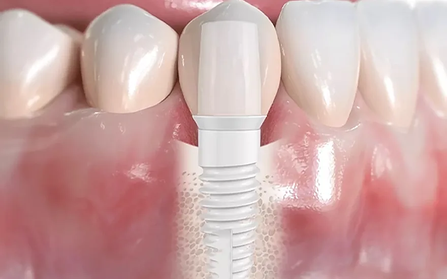 Metal-free ceramic dental implant integrated with the gum and natural teeth