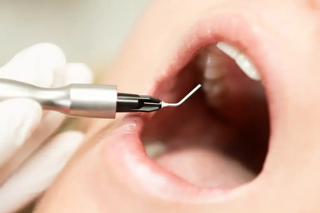 Gentle laser and ozone gum treatment for bacteria reduction at Green Dentistry in Alexandria, VA